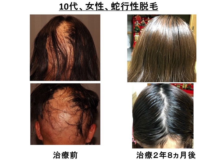 円形脱毛症　病院